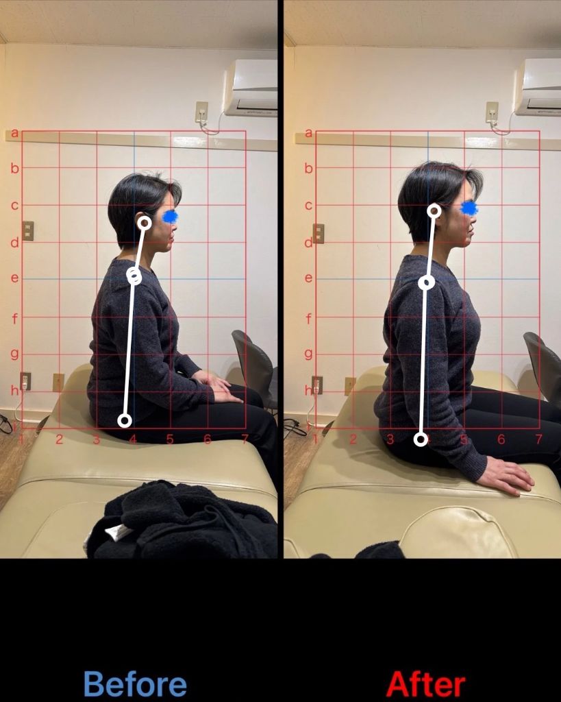 猫背矯正 施術結果1