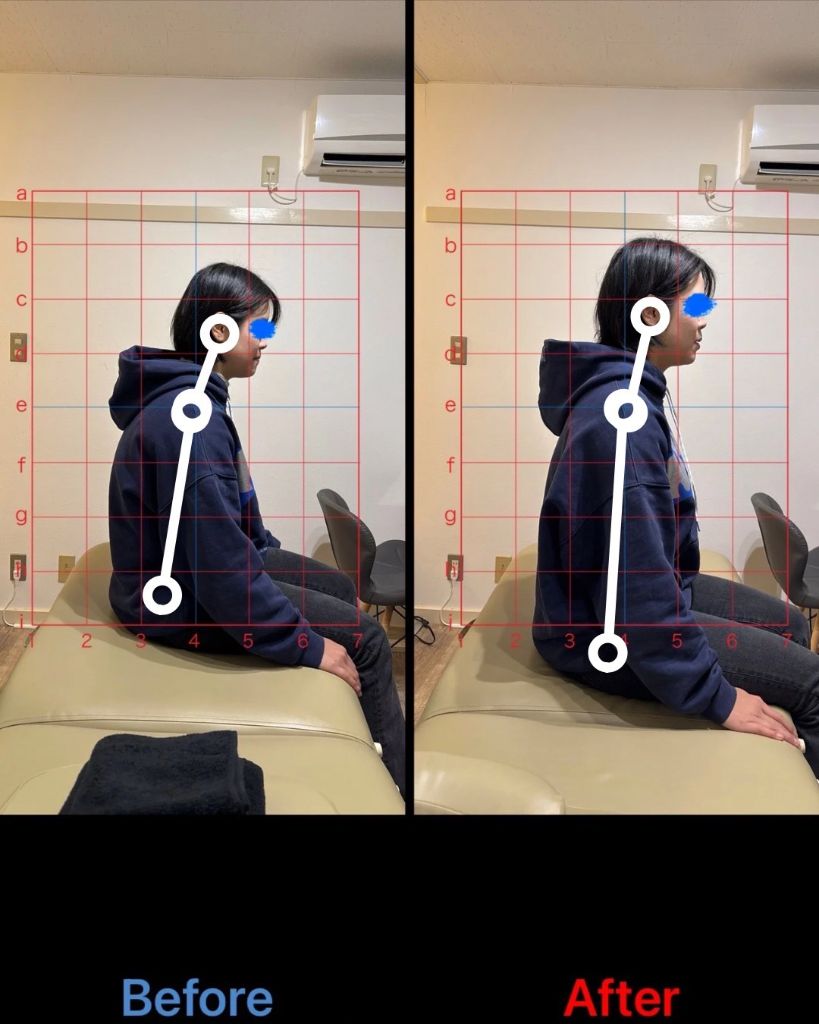 猫背矯正 施術結果2