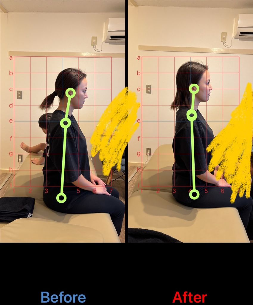 姿勢改善 施術結果3