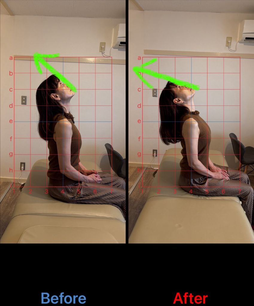 猫背矯正 施術結果4