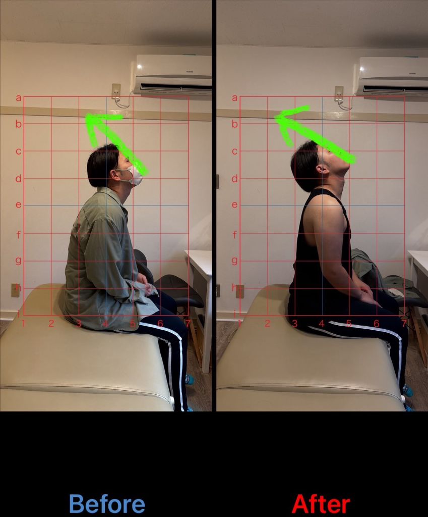 猫背矯正 施術結果6