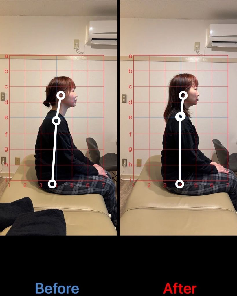 姿勢改善 施術結果7