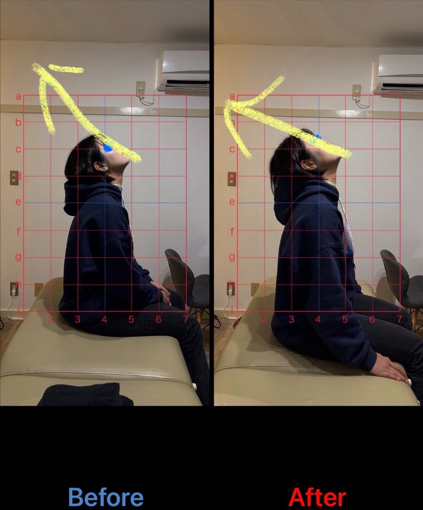姿勢改善 施術結果9