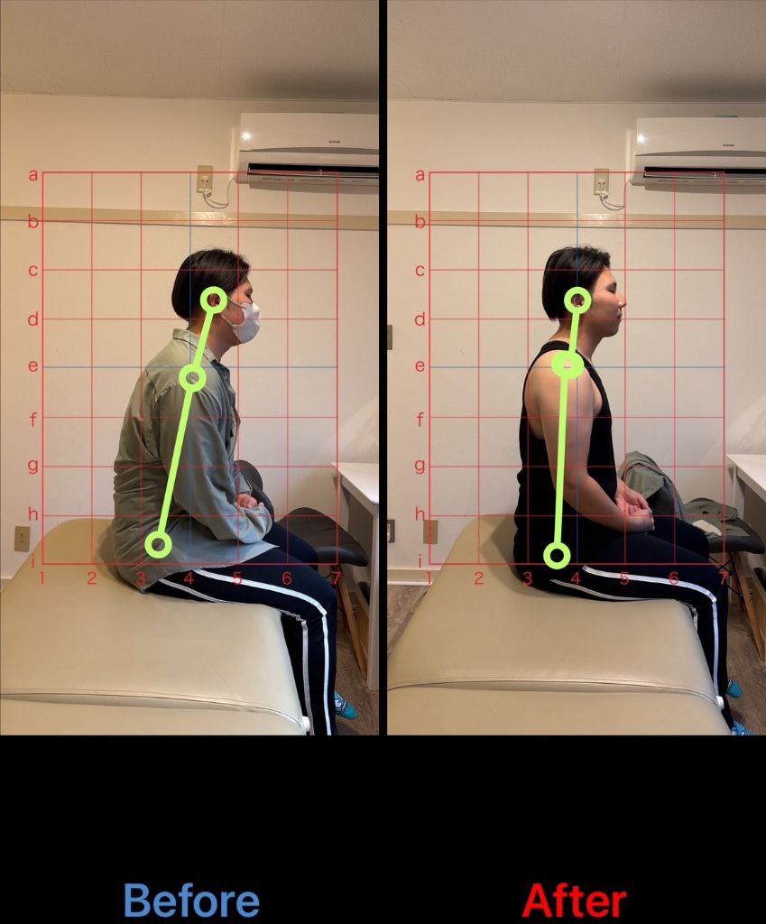 猫背矯正 施術結果12