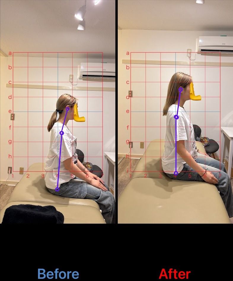 姿勢改善 施術結果16