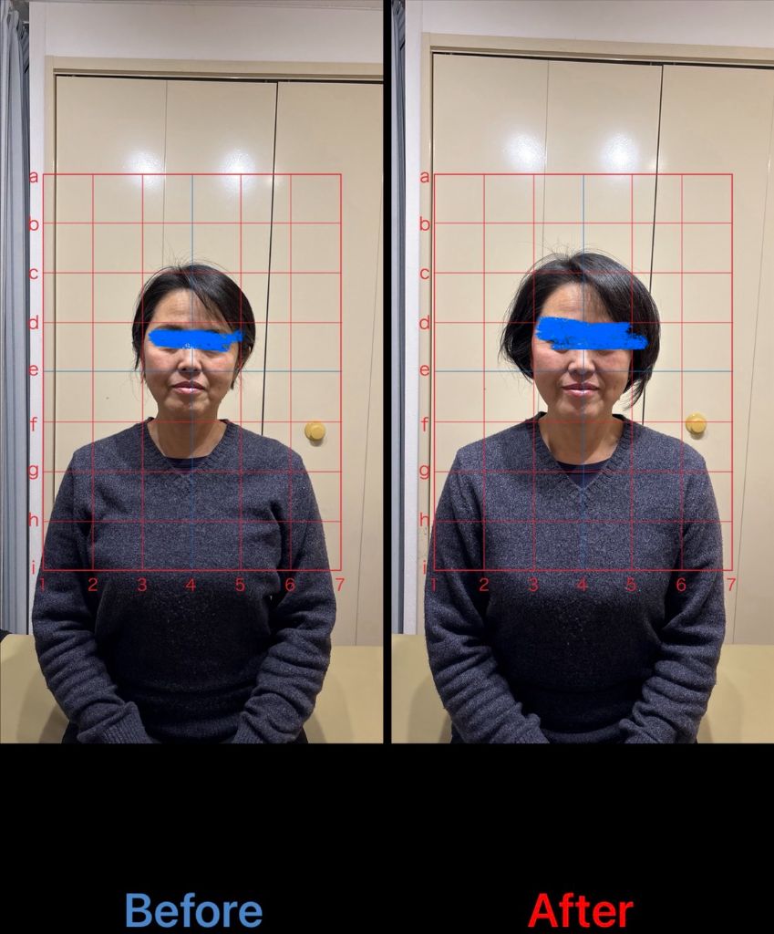 姿勢改善 施術結果17