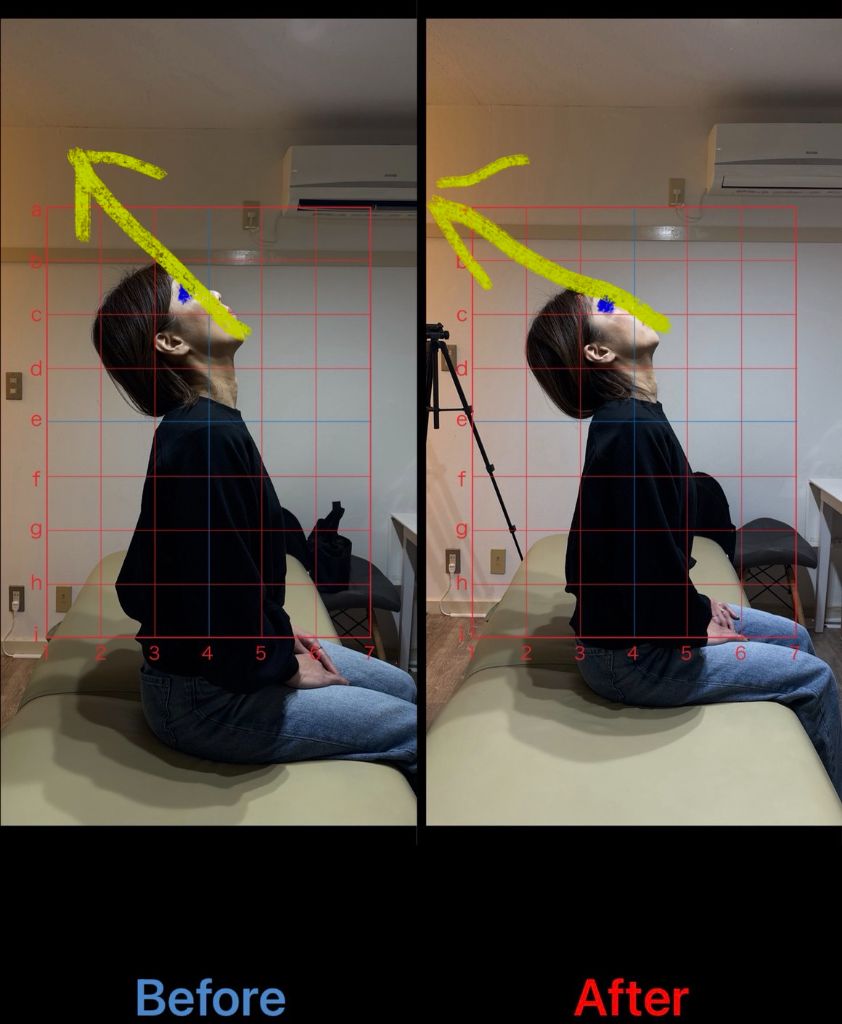 猫背矯正 施術結果20