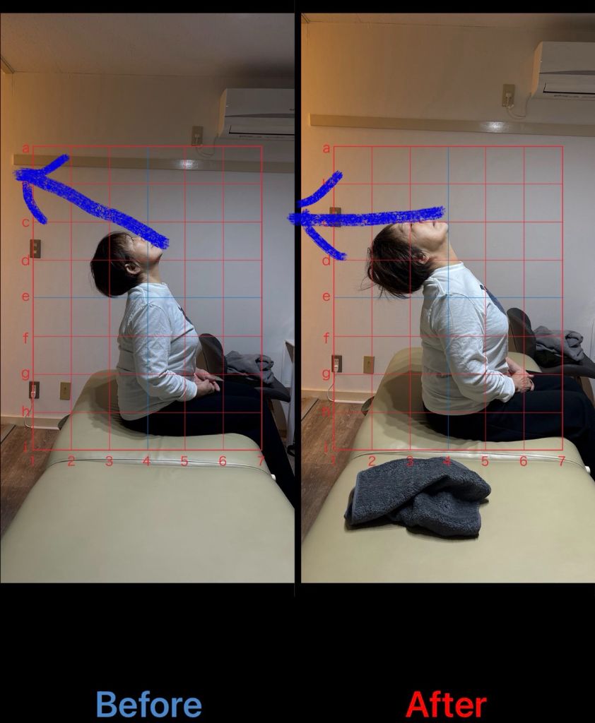 姿勢改善 施術結果21