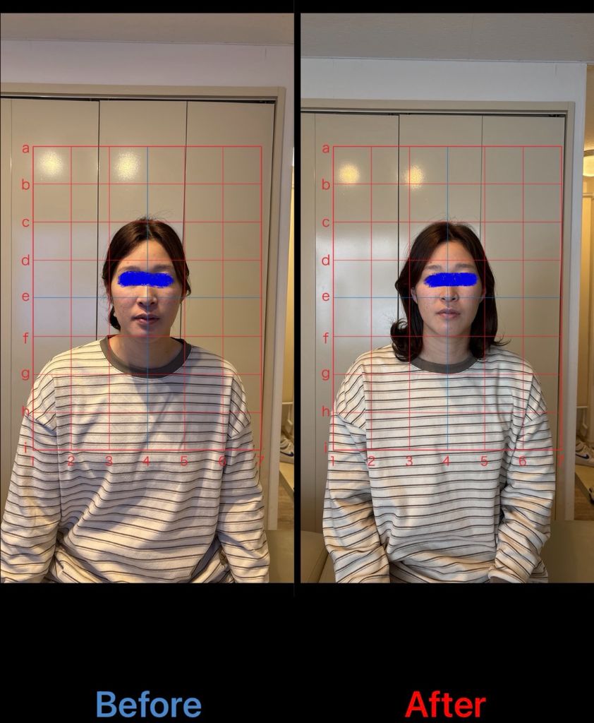 猫背矯正 施術結果22