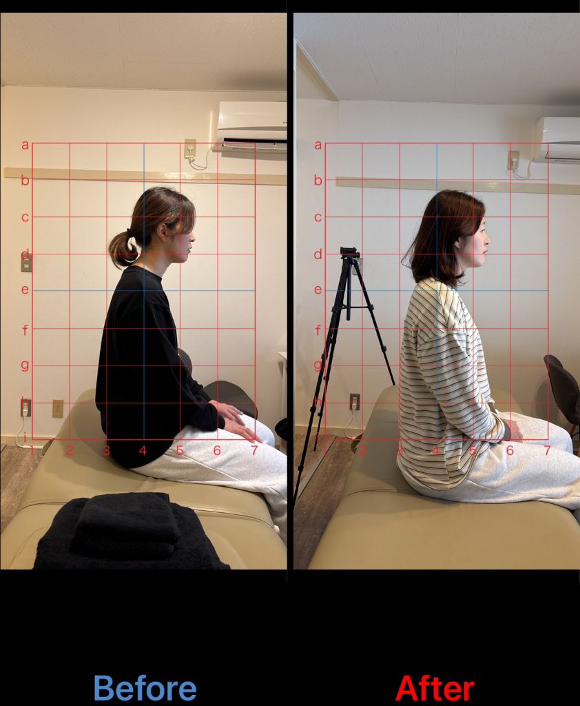 20代女性 ストレートネック改善事例