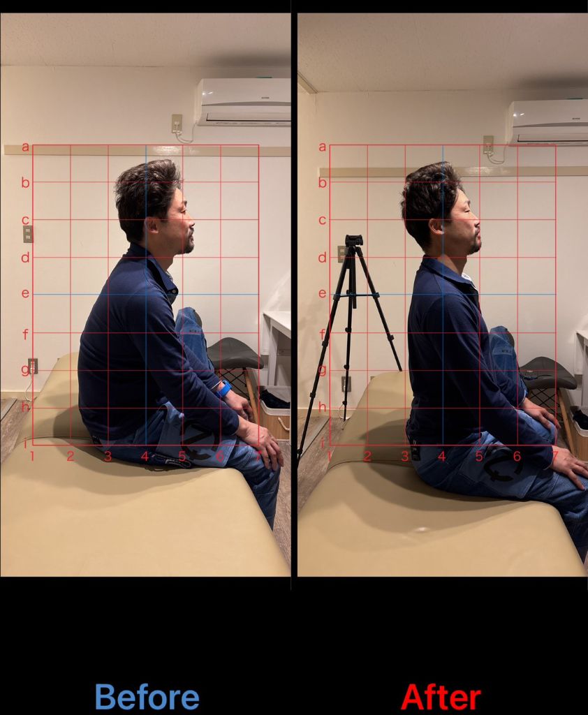 70代男性 慢性肩こり改善事例