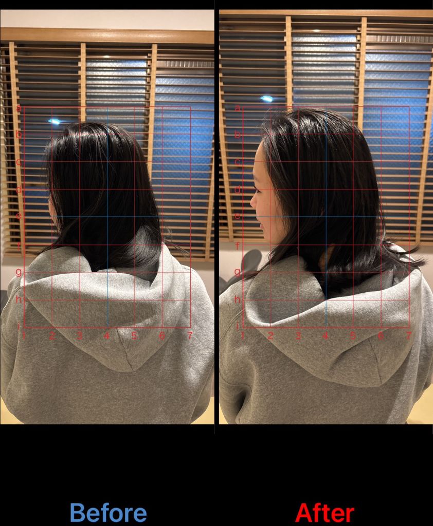 20代女性 首の寝違え改善事例