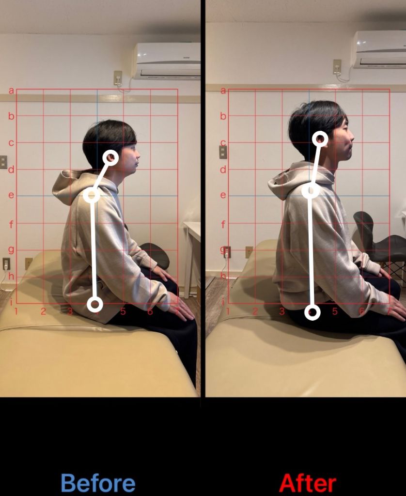 20代女性 猫背・頭痛改善事例