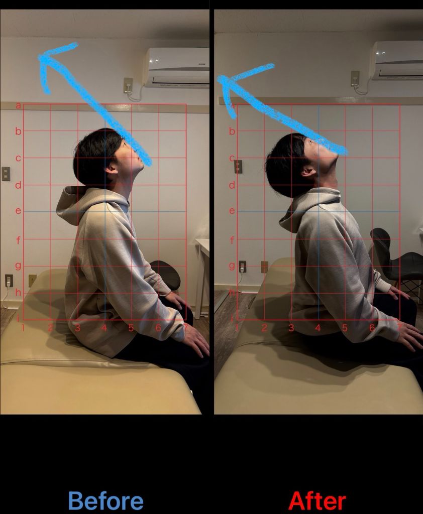 20代女性 猫背・頭痛改善事例2